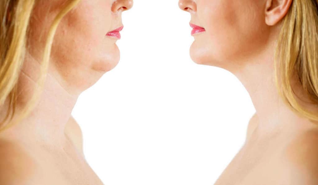 Double Chin treatment Dormer's Wells before and after results