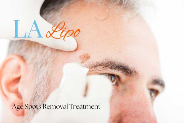 What Are the Most Effective Treatments for Age Spots Dormer's Wells?