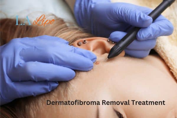 Dermatofibroma Removal Treatment Dormer's Wells