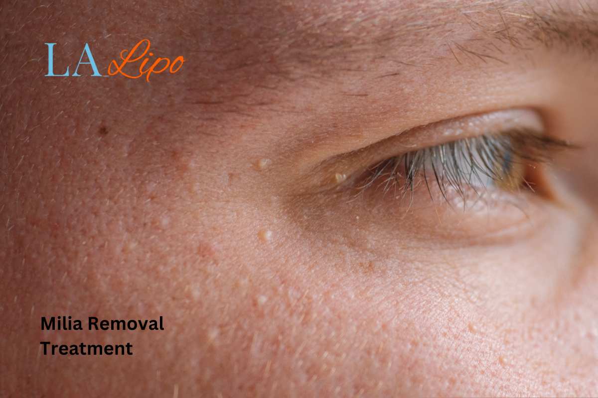 Cryopen Milia Removal: Is It the Easiest and Safest Option Dormer's Wells?