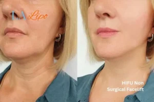 hi-fu for wrinkles Dormer's Wells before and after results