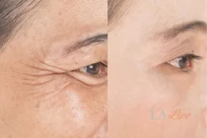 Before and after results of woman - HI-fu wrinkles reduction treatment Dormer's Wells