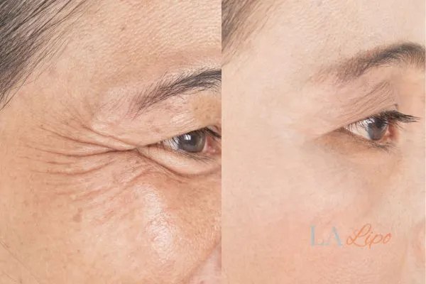 Before and after results of woman - HI-fu wrinkles reduction treatment Dormer's Wells