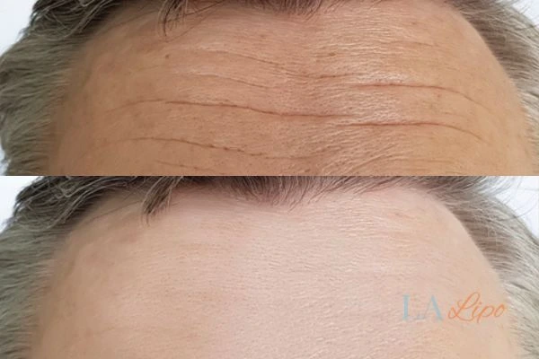 results of HIFU Dormer's Wells on mans forehead to help reduce lines and wrinkles