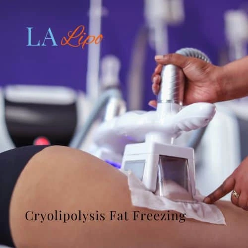 fat freezing - Cryolipolysis Dormer's Wells