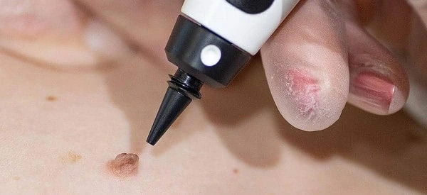 skin tag removal using cryopen Dormer's Wells