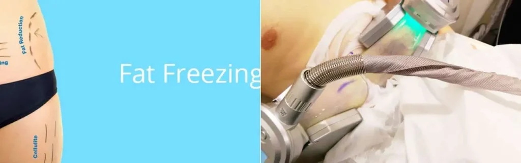 Fat freezing Dormer's Wells on multiple areas of the body