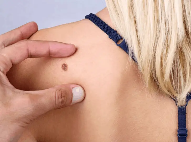 woman having mole removal Dormer's Wells consultation before treatment.