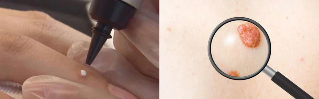 Person getting moles removed with cryopen Dormer's Wells