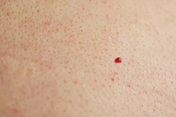 close up of a cherry angioma Dormer's Wells