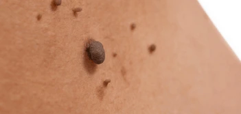 image of a skin tag Dormer's Wells