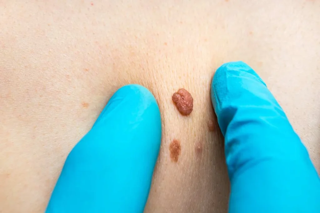 Consultant examining a skin tag Dormer's Wells