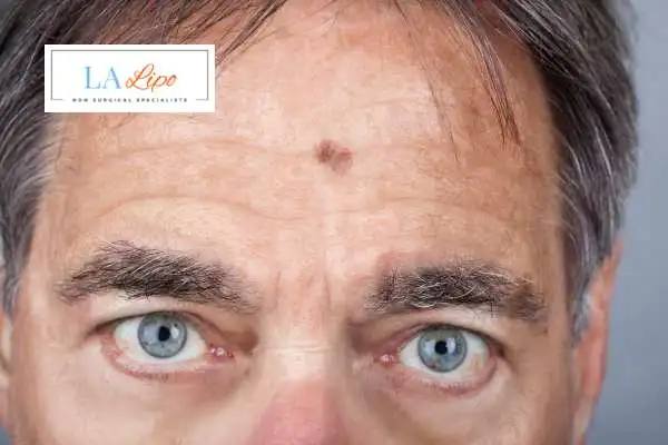 Solar Lentigo Removal Dormer's Wells image of man with mark on his forehead