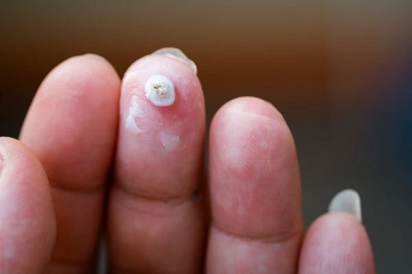 wart on person finger - cryotherapy to treat from LA LIPO Dormer's Wells