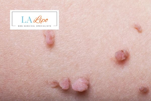 Does cryopen skin tag removal Dormer's Wells hurt? Find out now call our team today!
