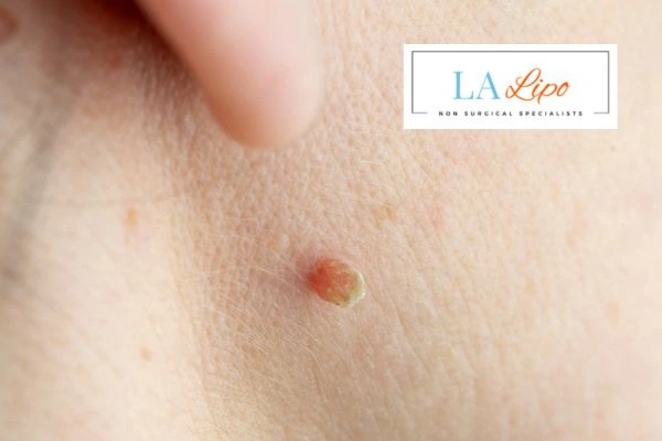 Book skin tag removal Dormer's Wells today speak to our team now!