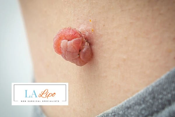 Interested in skin tag removal Dormer's Wells? Concerned about the pain? Find out more today!