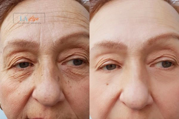 The powerful benefits of Morpheus8 Treatment Dormer's Wells - Call Our team today!