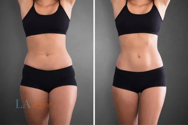 before and after results of non-surgical treatment to help a woman's body image and mental health Dormer's Wells