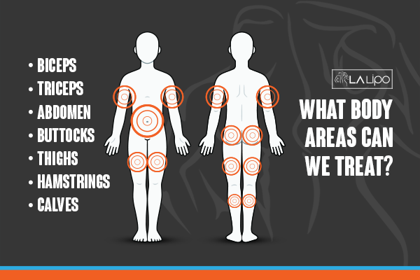 Diagram to show areas you can have LA-EMS Body Sculpting Treatment Dormer's Wells