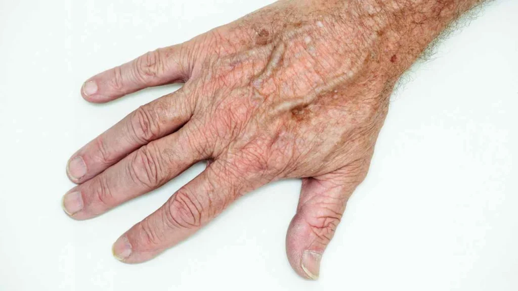 Male hand showing age spot Dormer's Wells