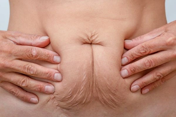 Image of a woman's stomach with loose skin - example of skin tightening Dormer's Wells options
