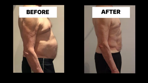 What Symptoms Can Diastasis Recti Cause in Men? Weak Core, Back Pain and Poor Posture Dormer's Wells